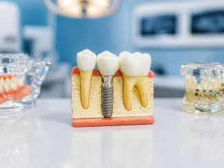 Dental illustration of an implant